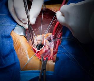 Increased mortality risk was linked to older age, atrial fibrillation, and COPD, among other factors. Increased mortality risk was linked to older age, atrial fibrillation, and COPD, among other factors.