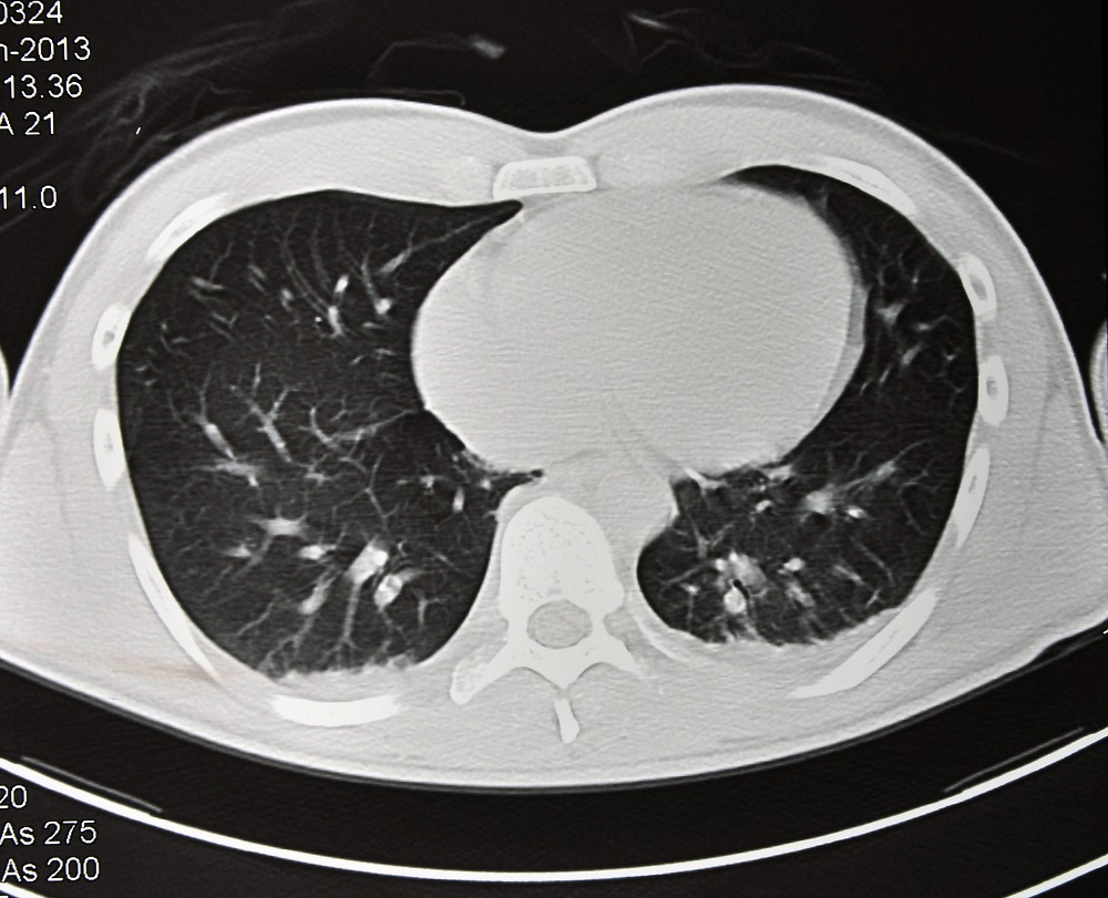 Chest Computed Tomography Use in COPD Assessment