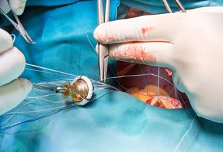 The Avalus is currently the only stented surgical aortic valve available. The Avalus is currently the only stented surgical aortic valve available.
