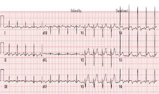 Prompt diagnosis after chest pain in young patients is vital for optimal outcomes. Prompt diagnosis after chest pain in young patients is vital for optimal outcomes.