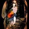 Cardiogenic Shock Associated With Poor Clinical Outcomes in Takotsubo Syndrome Cardiogenic Shock Associated With Poor Clinical Outcomes in Takotsubo Syndrome