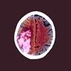 Following Ischemic Stroke, Glycemic Control Indicative of Short-Term Outcomes Following Ischemic Stroke, Glycemic Control Indicative of Short-Term Outcomes