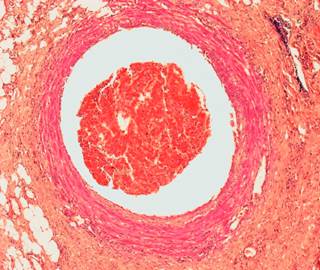 New-onset atrial fibrillation developed after noncardiac surgery is associated with a long-term risk of thromboembolism. New-onset atrial fibrillation developed after noncardiac surgery is associated with a long-term risk of thromboembolism.