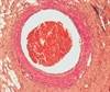 CHEST Releases Guideline for Antithrombotic Therapy in Atrial Fibrillation CHEST Releases Guideline for Antithrombotic Therapy in Atrial Fibrillation