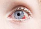Intraocular Bleeding Risk Reduced With NOACS Compared With Warfarin Intraocular Bleeding Risk Reduced With NOACS Compared With Warfarin