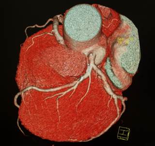Of 3 cohort studies evaluated for the effect of HCV infection on cardiovascular mortality, 1 study found a neutral effect. Of 3 cohort studies evaluated for the effect of HCV infection on cardiovascular mortality, 1 study found a neutral effect.