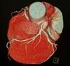 Examining Cardiovascular Disease Risk Associated With Hepatitis C Infection Examining Cardiovascular Disease Risk Associated With Hepatitis C Infection