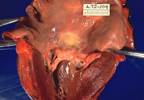 Rheumatic Heart Disease Mortality in Valve Replacement Surgery Rheumatic Heart Disease Mortality in Valve Replacement Surgery