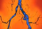 Parathyroidectomy for SHPT Reduces Aortic Calcification Parathyroidectomy for SHPT Reduces Aortic Calcification