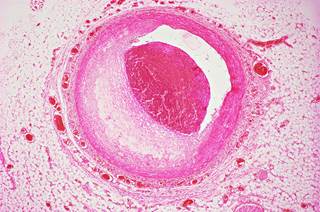 Researchers compared cardiovascular outcomes with monotherapy (either aspirin or rivaroxaban) with rivaroxaban plus aspirin dual therapy. Researchers compared cardiovascular outcomes with monotherapy (either aspirin or rivaroxaban) with rivaroxaban plus aspirin dual therapy.