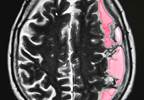 Black Atrial Fibrillation Patients Have Increased Risks for Strokes Black Atrial Fibrillation Patients Have Increased Risks for Strokes