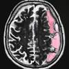 Risk Factors for Major Bleeding After Stroke With Antiplatelet Therapy Risk Factors for Major Bleeding After Stroke With Antiplatelet Therapy