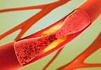 Acute Pancreatitis Linked to Diuretic in Coronary Artery Disease Acute Pancreatitis Linked to Diuretic in Coronary Artery Disease