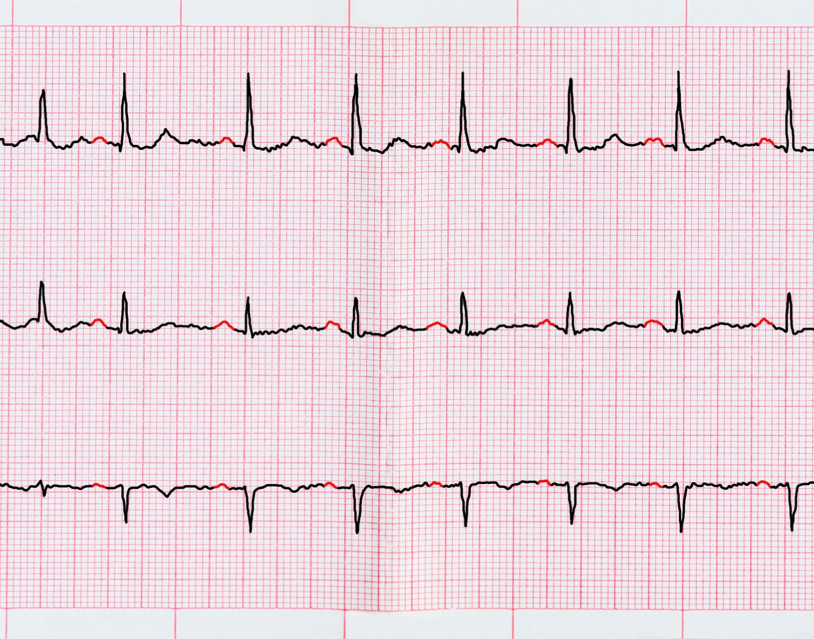 ecg-with-atrial-fibrillation