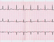 Atrial Fibrillation Mortality May Increase With Digoxin