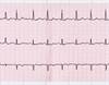 Worsening Shortness of Breath in Patient With Hypertension, Afib Worsening Shortness of Breath in Patient With Hypertension, Afib