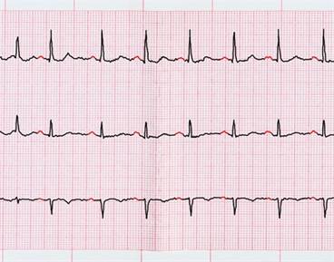 Worsening Shortness of Breath in Patient With Hypertension, Afib Worsening Shortness of Breath in Patient With Hypertension, Afib