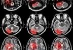 Acute Ischemic Stroke: Updated Guidelines From AHA/ASA Acute Ischemic Stroke: Updated Guidelines From AHA/ASA