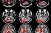 New S<sub>2</sub>TOP-BLEED Score Estimates Bleeding Risk in Ischemic Stroke New S<sub>2</sub>TOP-BLEED Score Estimates Bleeding Risk in Ischemic Stroke