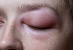 Angioedema Risk With Aliskiren vs Beta-Blockers Compared Angioedema Risk With Aliskiren vs Beta-Blockers Compared