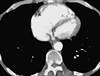 Supraventricular Arrhythmia in PAH Predicted by Right Atrium Enlargement Supraventricular Arrhythmia in PAH Predicted by Right Atrium Enlargement