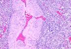Idiopathic PAH-Associated Hypoxemia Linked to Poor Survival, Increased Comorbidities Idiopathic PAH-Associated Hypoxemia Linked to Poor Survival, Increased Comorbidities