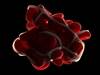 DAPT Effective, Safe for Prophylaxis of Arterial Thrombosis in Antiphospholipid Syndrome DAPT Effective, Safe for Prophylaxis of Arterial Thrombosis in Antiphospholipid Syndrome