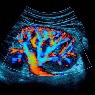 Acute kidney injury was independently associated with higher rates of hospitalization for heart failure and atherosclerotic events. Acute kidney injury was independently associated with higher rates of hospitalization for heart failure and atherosclerotic events.