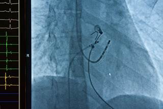 At 1-year, in the non-PV ablation group, 90% were arrhythmia free off-AAD. At 1-year, in the non-PV ablation group, 90% were arrhythmia free off-AAD.