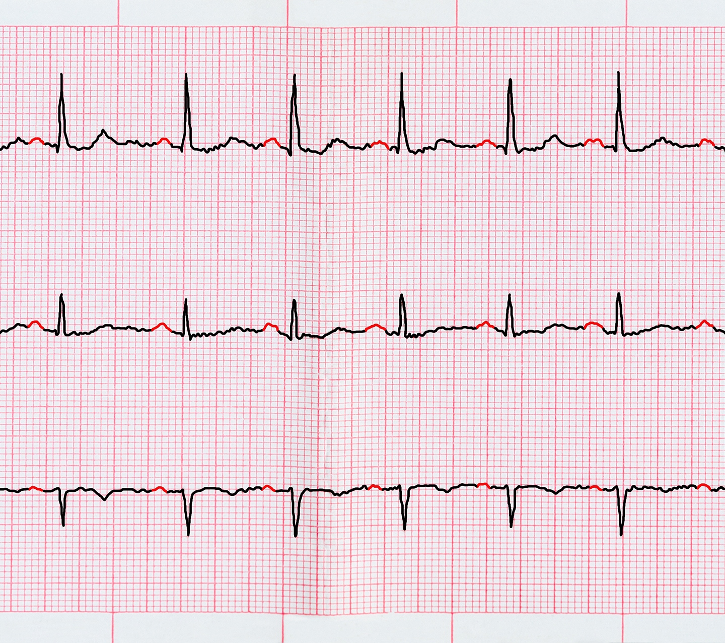 hyoscyamine-helps-in-afib-with-slow-ventricular-response