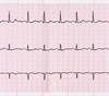COPD May Increase the Risk for Atrial Fibrillation COPD May Increase the Risk for Atrial Fibrillation