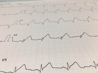 The harms of diagnostic follow-up and treatment resulting from abnormal ECG results include misdiagnosis and invasive testing. The harms of diagnostic follow-up and treatment resulting from abnormal ECG results include misdiagnosis and invasive testing.