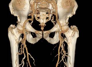 The 2017 peripheral arterial disease guidelines stress the importance of preventing cardiovascular events. The 2017 peripheral arterial disease guidelines stress the importance of preventing cardiovascular events.