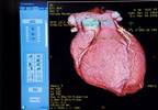 Positron Emission Tomography Offers Diagnostic Value in Myocardial Ischemia Positron Emission Tomography Offers Diagnostic Value in Myocardial Ischemia