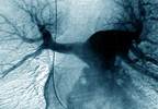 Intermediate-Risk Pulmonary Embolism Treatment With Dabigatran Intermediate-Risk Pulmonary Embolism Treatment With Dabigatran