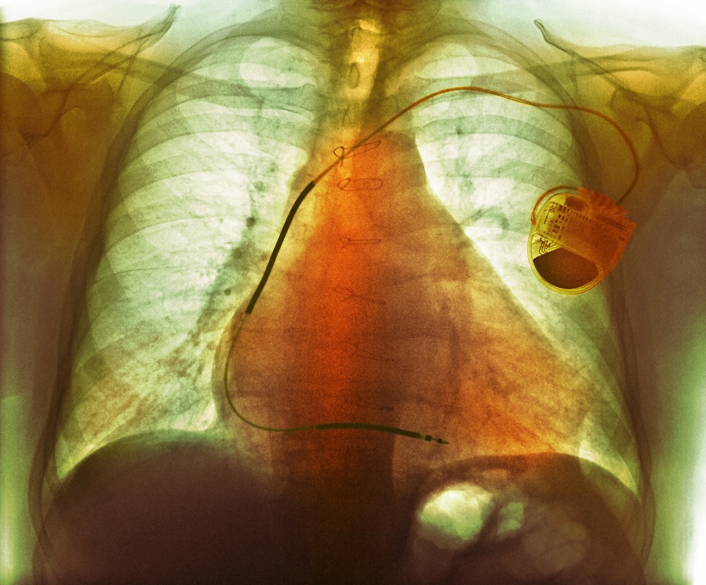 Lower Afib Risk With AdaptivCRT vs Conventional Cardiac