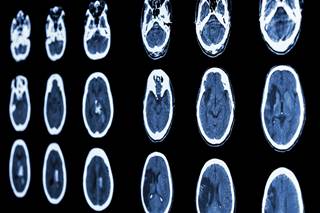 Ischemic stroke, extracranial bleeding rates similar; lower risk of intracranial bleeding with dabigatran. Ischemic stroke, extracranial bleeding rates similar; lower risk of intracranial bleeding with dabigatran.