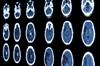 Reducing Neurologic Damage After Stroke With Ischemic Preconditioning Reducing Neurologic Damage After Stroke With Ischemic Preconditioning