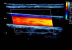 No Impact on Carotid Artery Intima-Media Thickness Following Cessation of Menopausal Hormone Therapy No Impact on Carotid Artery Intima-Media Thickness Following Cessation of Menopausal Hormone Therapy
