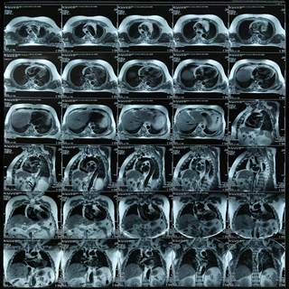 Overall, 44% of patients showed LGE presence, which correlated with increased risk of MACE. Overall, 44% of patients showed LGE presence, which correlated with increased risk of MACE.