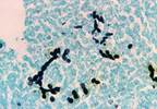 Acute Myocarditis Complicated by LVSD Has Different Presentation, Outcomes Acute Myocarditis Complicated by LVSD Has Different Presentation, Outcomes