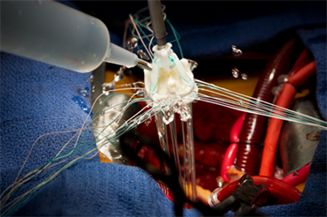 Aortic valve replacement linked to increased mortality in elderly Aortic valve replacement linked to increased mortality in elderly