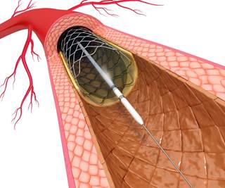 BVSs were correlated with increased risks for myocardial infarction, target lesion revascularization, and target lesion failure. BVSs were correlated with increased risks for myocardial infarction, target lesion revascularization, and target lesion failure.