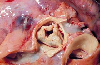 LVEF may be a useful tool in predicting survival in severe aortic stenosis. LVEF may be a useful tool in predicting survival in severe aortic stenosis.