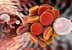 Pharmacomechanical thrombolysis does not reduce post-thrombotic syndrome in DVT Pharmacomechanical thrombolysis does not reduce post-thrombotic syndrome in DVT