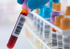 Metabolic Syndrome Common With Chronic Hepatitis B Infection Metabolic Syndrome Common With Chronic Hepatitis B Infection