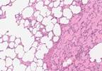 Prognostic Value of CT Signs of Pulmonary Veno-occlusive Disease Prognostic Value of CT Signs of Pulmonary Veno-occlusive Disease