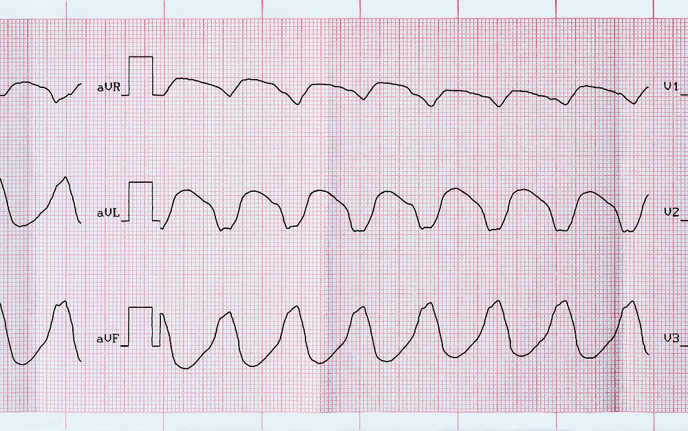 ACC/AHA/HRS Release Updated Guidelines for Ventricular Arrhythmia Management