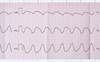 COPD May Predict Mortality in Ventricular Tachyarrhythmias, Sudden Cardiac Arrest COPD May Predict Mortality in Ventricular Tachyarrhythmias, Sudden Cardiac Arrest