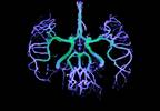 Impaired Cerebral Pressure-Flow Link in Pulmonary Arterial Hypertension Impaired Cerebral Pressure-Flow Link in Pulmonary Arterial Hypertension